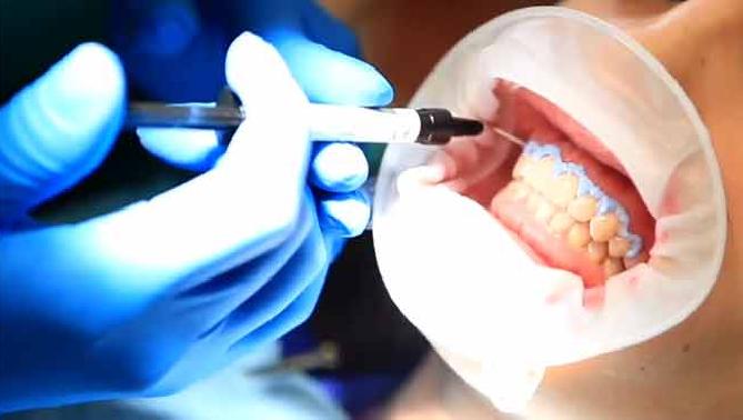 blanqueamiento dental proceso